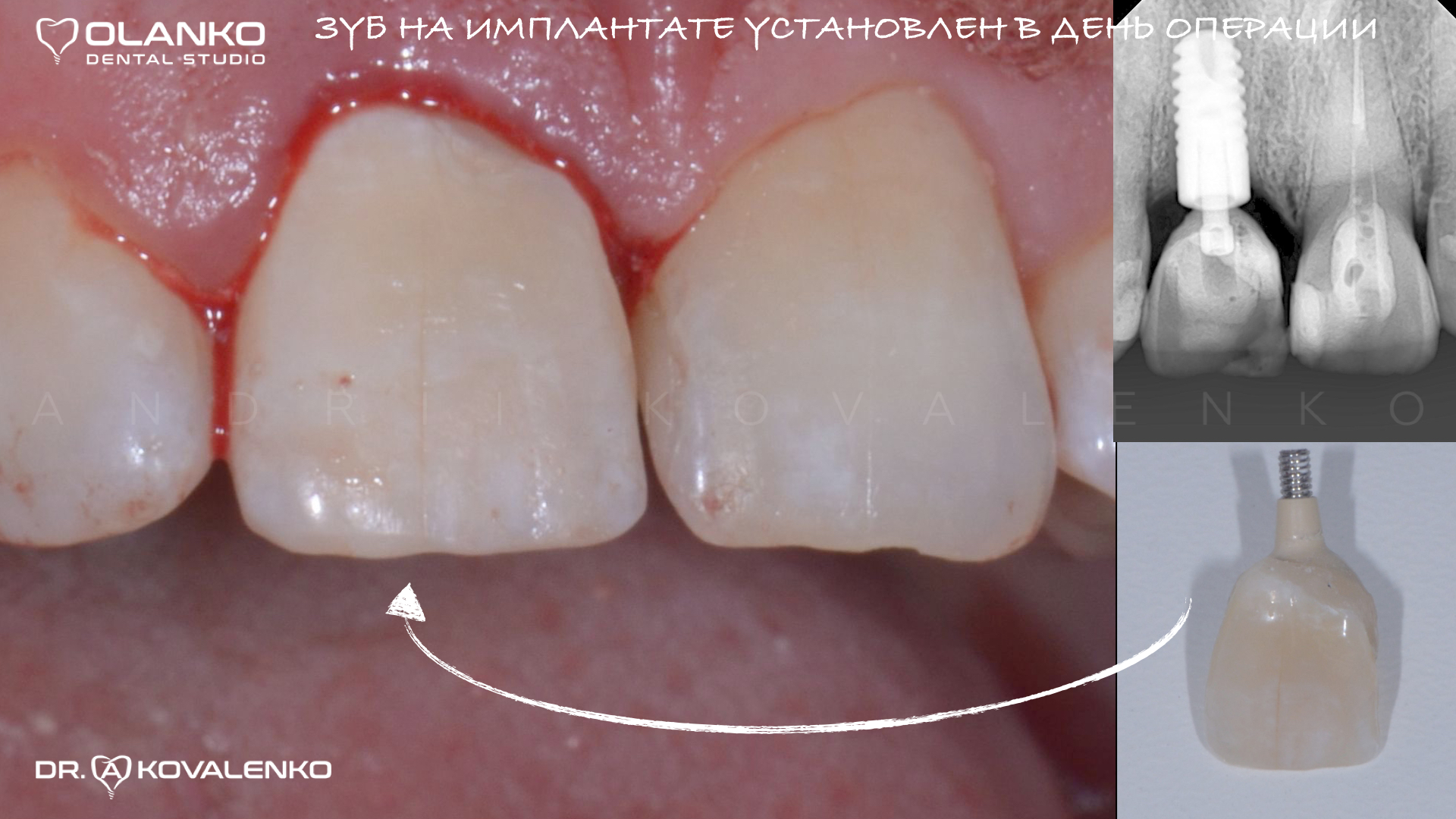 Зуб за 1 день Імплантант на верхній передній зуб | Olanko